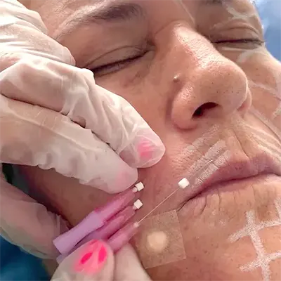 img-Hilos tensores Bogotá-1-movil