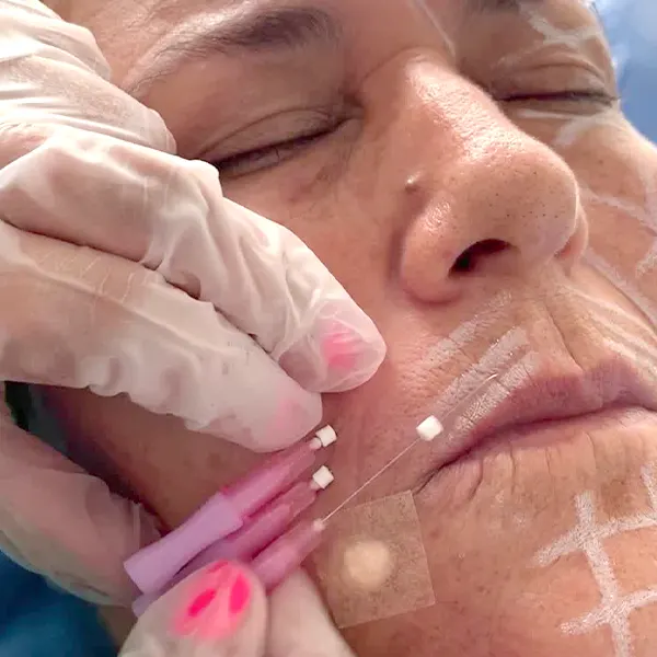 img-Hilos tensores Bogotá-1